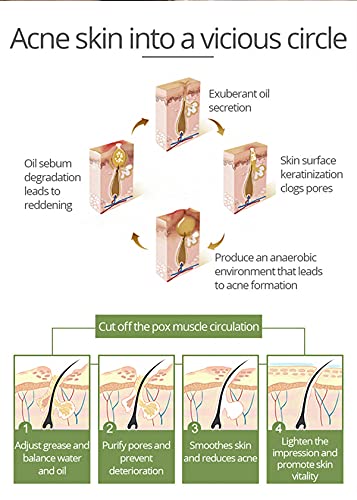 Aichun Beauty Anti Acne Face Serum 30ml